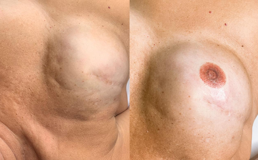 Micropigmentação paramédica transforma vidas ao camuflar imperfeições na pele