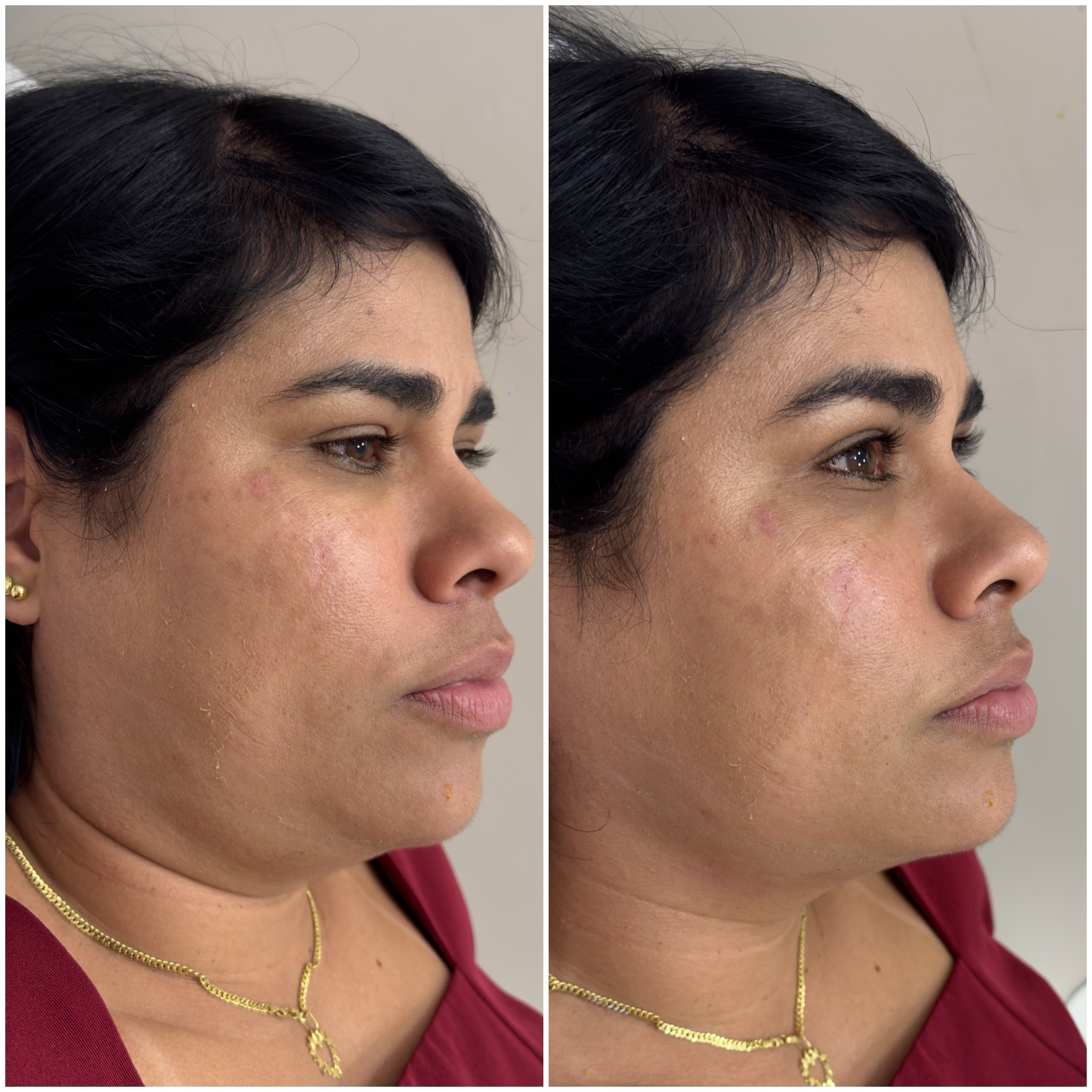 Tecnologia de ultrassom estimula colágeno e redefine contornos faciais e corporais