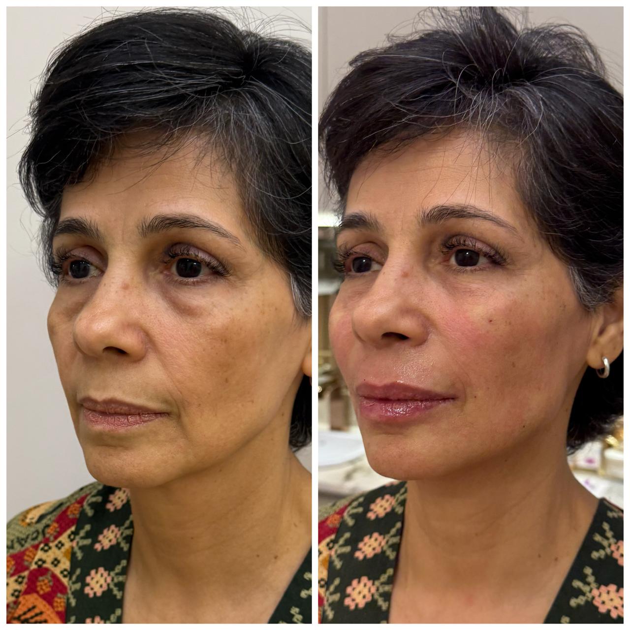 Bigode chinês pode ser suavizado sem cirurgia para as festas de fim de ano