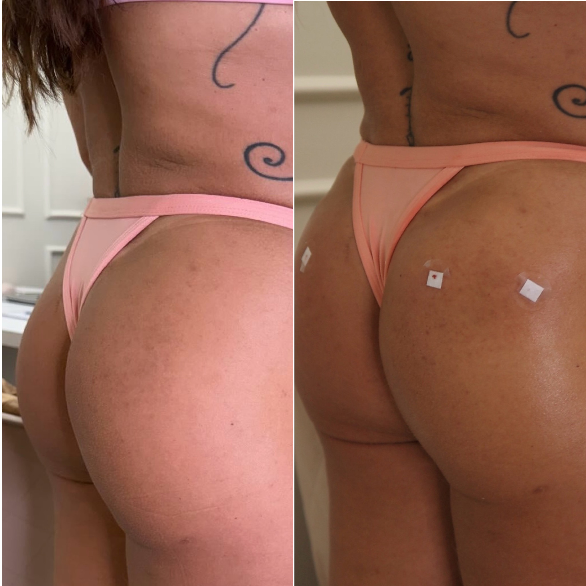 Harmonização de glúteos ganha espaço como alternativa estética para volume e definição com naturalidade