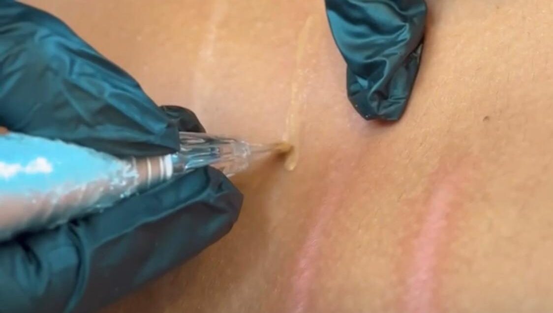 Camuflagem de estrias e cicatrizes devolve autoestima e ganha destaque no Mês da Mulher