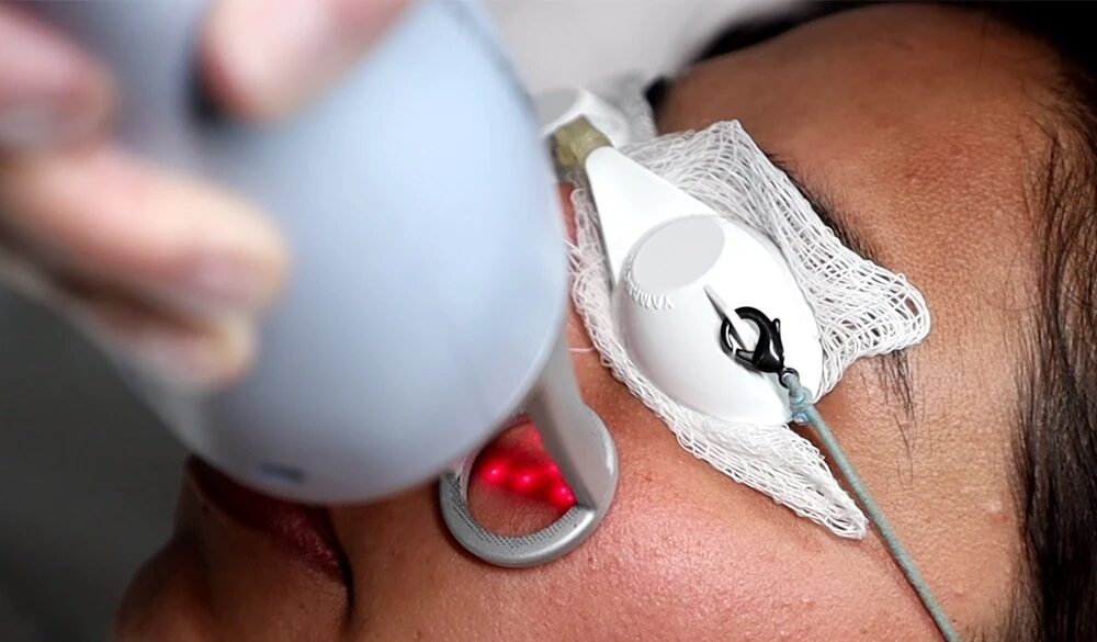 Laser Lavieen ganha espaço na estética por unir renovação da pele e melhora da textura